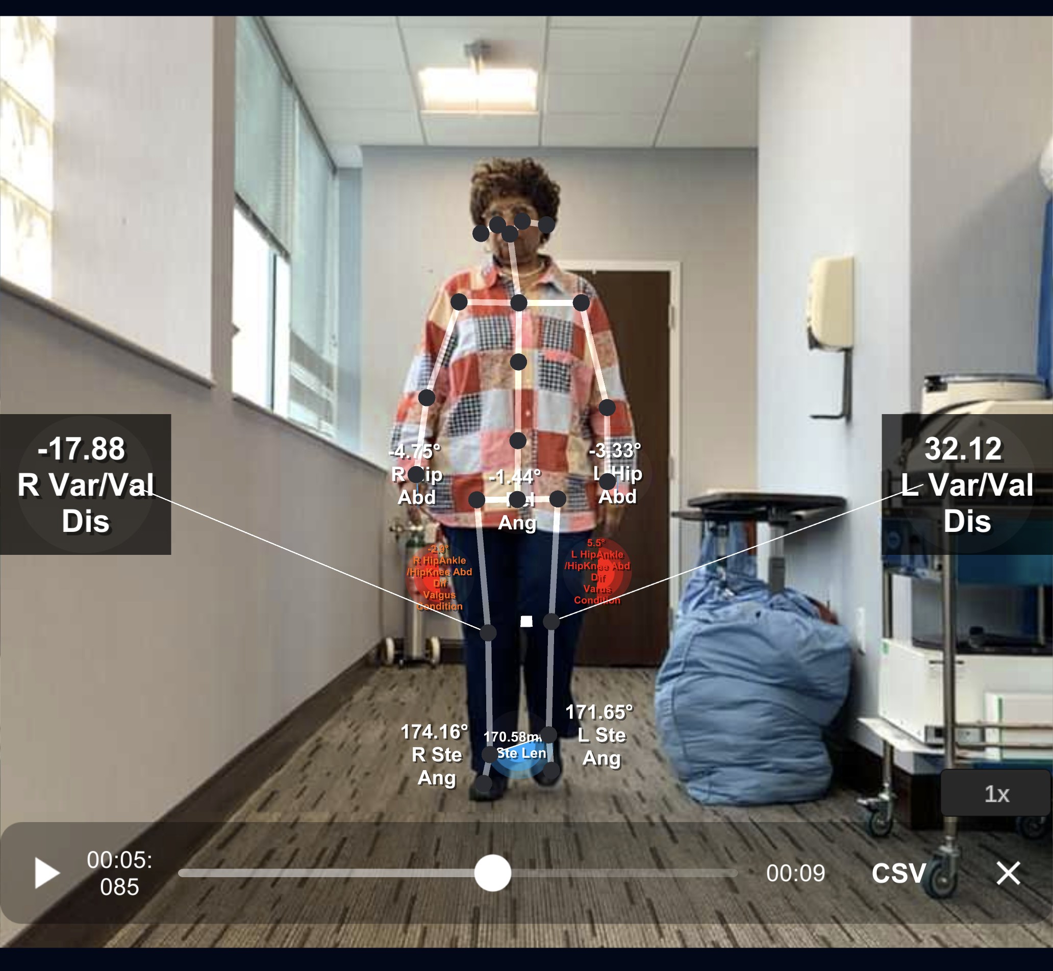Knee joint alignment X-ray measurements showing FMA, mLDFA, MPTA, TALA, KAA, and JLCA angles